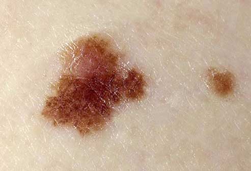 skin cancer moles pics Dysplastic-Naevi