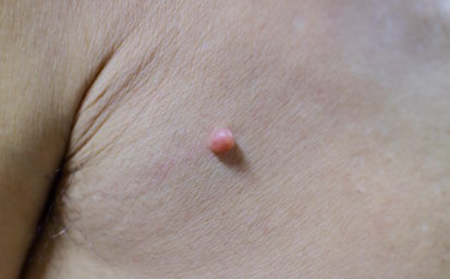 Acrochordon or skin tag near armpit
